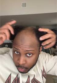 Bald Man Styles Hair in a Bun: A Unique Transformation