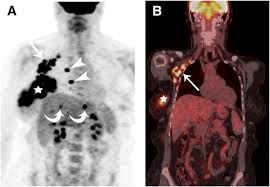 A low dose ct scan of the chest exposes patients to 1.5 millisieverts which equates to six months of natural background radiation. Retrospective Study Of 18f Fdg Pet Ct In The Diagnosis Of Inflammatory Breast Cancer Preliminary Data Journal Of Nuclear Medicine