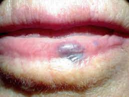 Apart from sometimes causing a cosmetic blemish, angiomas are reported to be asymptomatic (without noticeable symptoms). Vascular Proliferations And Abnormalities Of Blood Vessels Dermnet Nz