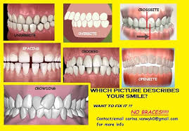 There are three ways an overbite can be corrected: A3rfqc Becxym