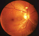 Image result for HIV Retinitis