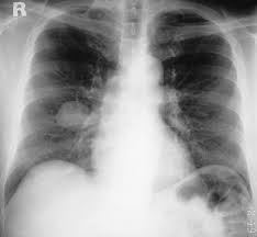 Coarse calcification in popcorn configuration is a classic features of pulmonary hamartoma. Pulmonales Hamartom Eref Thieme