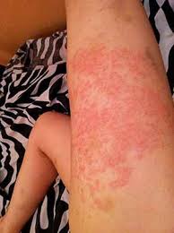 Dermatitis Herpetiformis Diagnosing And Treating The Gluten Rash Gluten Rash Dermatitis Herpetiformis Celiac Disease
