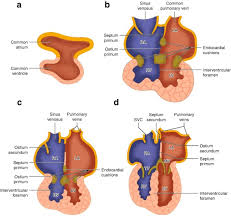 Image result for Endocardial Cushion Defect