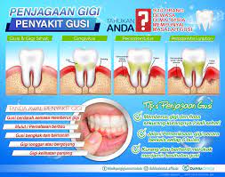 Sakit gusi bukan menular tapi jangan dipandang sepele karena aroma gusi yang sakit sangat tidak nyaman, sakit gusi bisa datang ketika tumbuh gigi, atau sakit gusi pada gigi yang belubang, dan biasanya sakit gusi ini ada di belakang dan gigir atau sisi gigi, penyebab sakit gusi bisa. Penyakit Gusi Bengkak Dan Klinik Pergigian Nur Salam Facebook