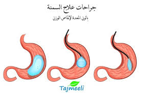 عملية بالون المعدة تكلفة و التجارب و الفوائد و الاضرار تجميلي