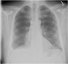 Maybe you would like to learn more about one of these? Case Report Steroid Responsive Mesothelioma Related Pleural Effusion Sciencedirect