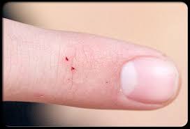 Most appear as tiny, red bumps on your skin that are sometimes painful and itchy. Pin On Dermatology Nursing