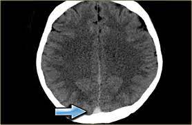 Thrombosis of cerebral veins and venous sinuses is a rare disease, which accounts for less than 1% of all cases of stroke. The Radiology Assistant Cerebral Venous Thrombosis
