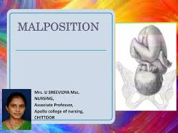 Image result for Manual Rotation in Occipitoposterior Presentation