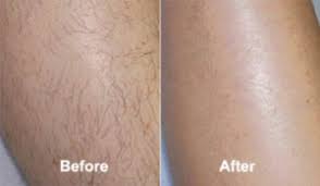 Hair removal cream, also known as depilatory creams, are chemicals that break down the keratin of your hair. Should You Use Hair Removal Creams Beauty Intensified
