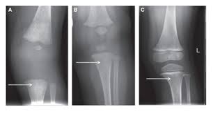 Image result for Intraosseous Access