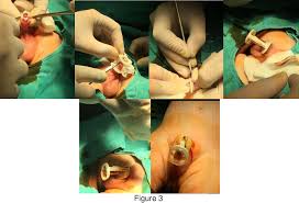 Image result for Neonatal Circumcision