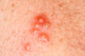 You may feel itchy or tingly around your genitals. Hsv 2 Keyword Search Science Photo Library