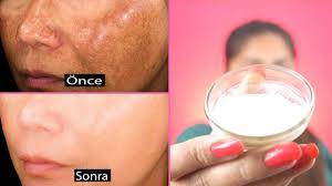 5 Dakikada Ciltteki Lekeleri Yok Et Gunes Lekeleri Icin Dogal Cozum Beyazlatma Guzellik Bakim Youtube