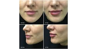 How much dermal filler needs to be injected. Juvederm Cost Side Effects And Risks