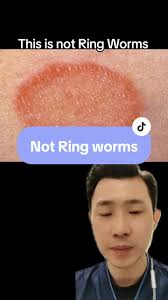 Pityriasis rosea is a self-limiting rash, which resolves in about 6–10  weeks. It is characterised by a large circular or oval "herald patch",  usually found