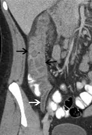 Image result for Neutropenic Colitis