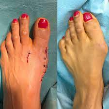 Das prinzip aller methoden ist weitgehend gleich: Operation Hallux Valgus