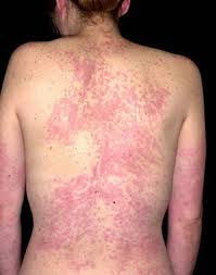 Image result for Papular urticaria