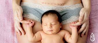 Cuidados Postparto Por Cesarea Consejos De Maternidad Reina Madre