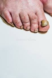 Image result for Onycholysis feet