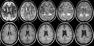 Widespread use of mri (magnetic resonance imaging) has revolutionized the ability to diagnose multiple sclerosis. Advanced Mri May Speed Diagnosis Of Multiple Sclerosis