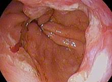 But, first, you need to know when to seek medical attention. Esophageal Cancer Wikipedia