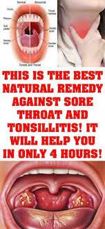 Cure Tonsillitis And Sore Throat In Only Few Hours Remedies For Swollen Tonsils Throat Remedies Tonsilitis Remedy
