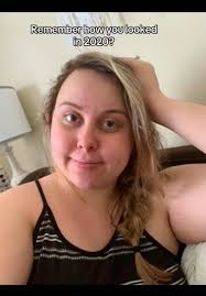 Transforming My Body After Gastric Bypass Surgery