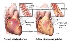 This condition is usually caused by atherosclerosis. Coronary Heart Disease University Hospitals
