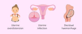 Image result for Preterm Labor