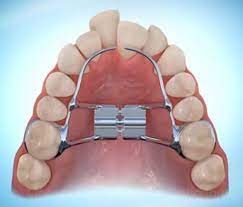 What To Expect With Your Child S Orthodontic Expander Orthodontic Appliances Orthodontics Palate Expander