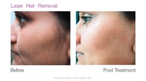 This could lead to infection or ingrown hairs, so we recommend waiting at least 24 hours after a laser hair removal treatment before attempting any activity that may increase your body temperature and upset the hair follicles. Laser Hair Removal Lasermed Llc