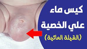 اسباب انتفاخ الخصية عند الاطفال كيس ماء علي الخصية القيلة المائية Youtube