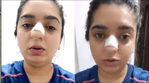 Woman Alleges Zomato Delivery Man Punched Her Leaves Her Bleeding With Broken Nose