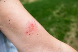 Poison ivy is sometimes the downside to a great hike and time outdoors, but don't let it stop you! How To Treat Poison Ivy Or Oak Osf Healthcare