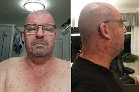 Brennkopper er en betennelse som skyldes en bakterie, og er vanligst blant barn. Vannkopper Sykdom Tore Ble Rammet Av Barnesykdom I Voksen Alder Folte Meg Som Et Sykt Monster