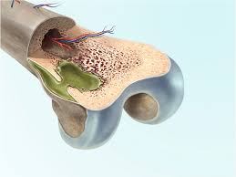 Osteomyelitis | Homeopathic | Best Homeopathic Doctor in Pakistan | Dr Qaisar Ahmed MD, DHMS