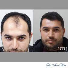 New The 10 Best Hairstyles With Pictures Kas Tip Merkezi Olarak Sac Ekiminde Guven Ve Basarinin Adresi O Hair Loss Remedies Hair Loss Hair Loss Symptoms