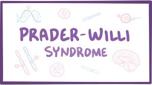 Prader Willi Syndrome Causes Symptoms Diagnosis Treatment Pathology
