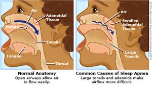 Image result for Obstructive Sleep Apnea