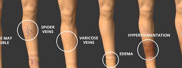 Varicose veins, venous insufficiency and leg ulcer treatments insurance coverage is always dependent upon benefit eligibility, as outlined in your specific benefit plan. Varicose Veins And Spider Veins Are Not The Same Dr Darling Kcmo