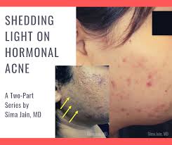 Acne here will come and go based on your cycle (as a woman) or if you're dealing with an excess of male hormones called androgens. Part 1 Hormonal Acne Exam Work Up Diagnosis Next Steps In Dermatology