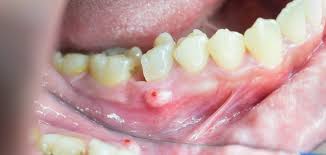 A periodontal abscess begins in the a gum abscess is usually visible from the moment it begins. Parulis Fistula Dental Abscess Treatment And Symptoms Maiden Lane