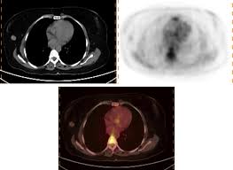 When breast cancer cancer spreads. Pet Pet Ct And Pet Mr Imaging Assessment Of Breast Cancer Pet Clinics