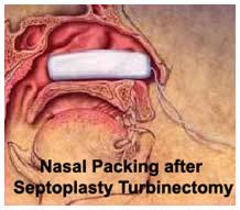 Image result for Nasal Packing