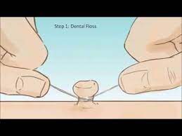 Top 5 Home Remedies To Remove Skin Tags How To Remove Skin Tags Easily At Home Youtube Skin Tags Home Remedies Skin Tag On Eyelid Skin Tag Removal