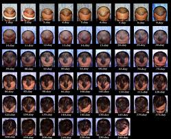 After three and four months of the surgery, the hair will start growing at least half inch per month. How Long Do Hair Transplant Last Recovery And Expectations Rephair