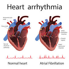 Image result for Atrial Fibrillation